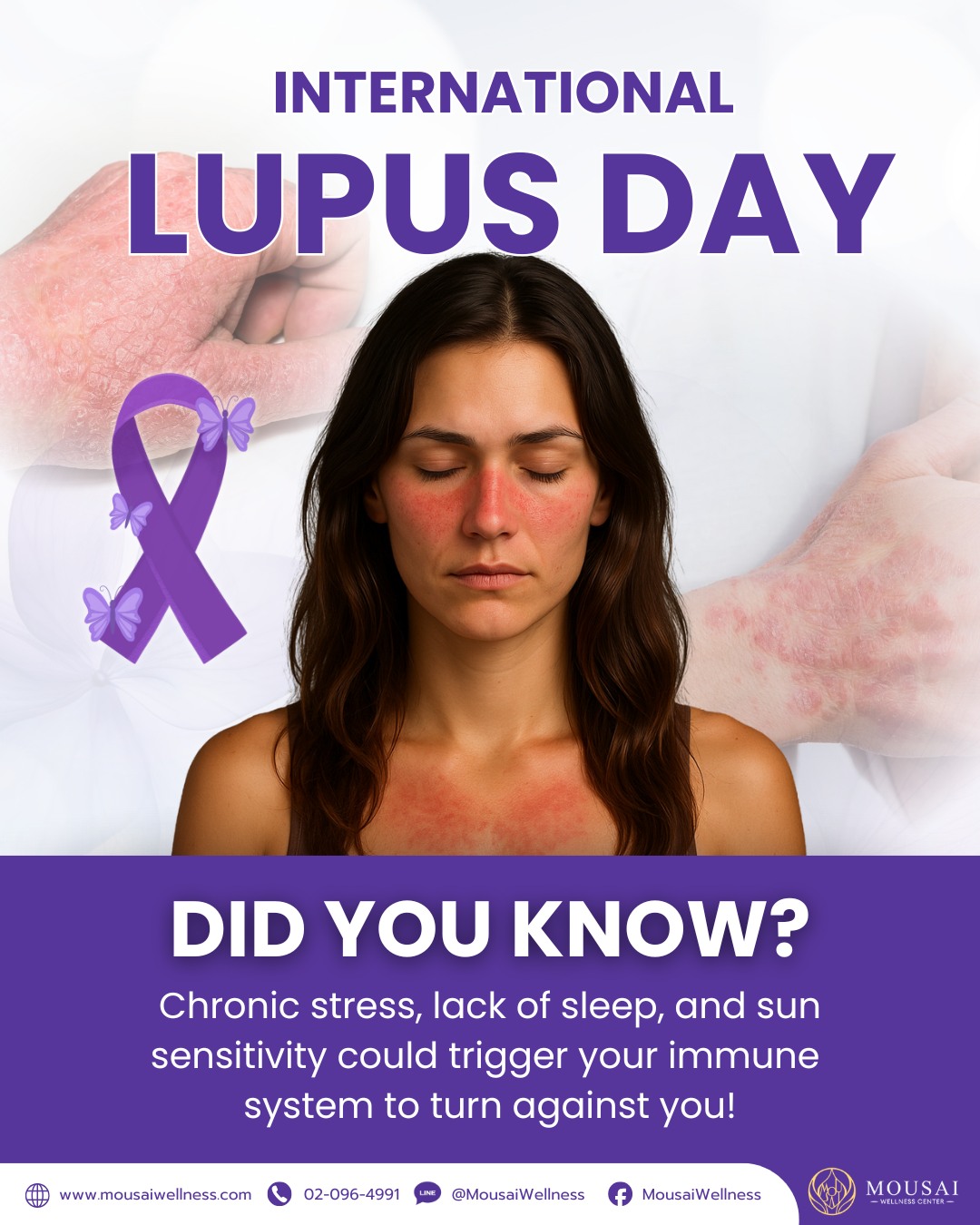 International Lupus Day