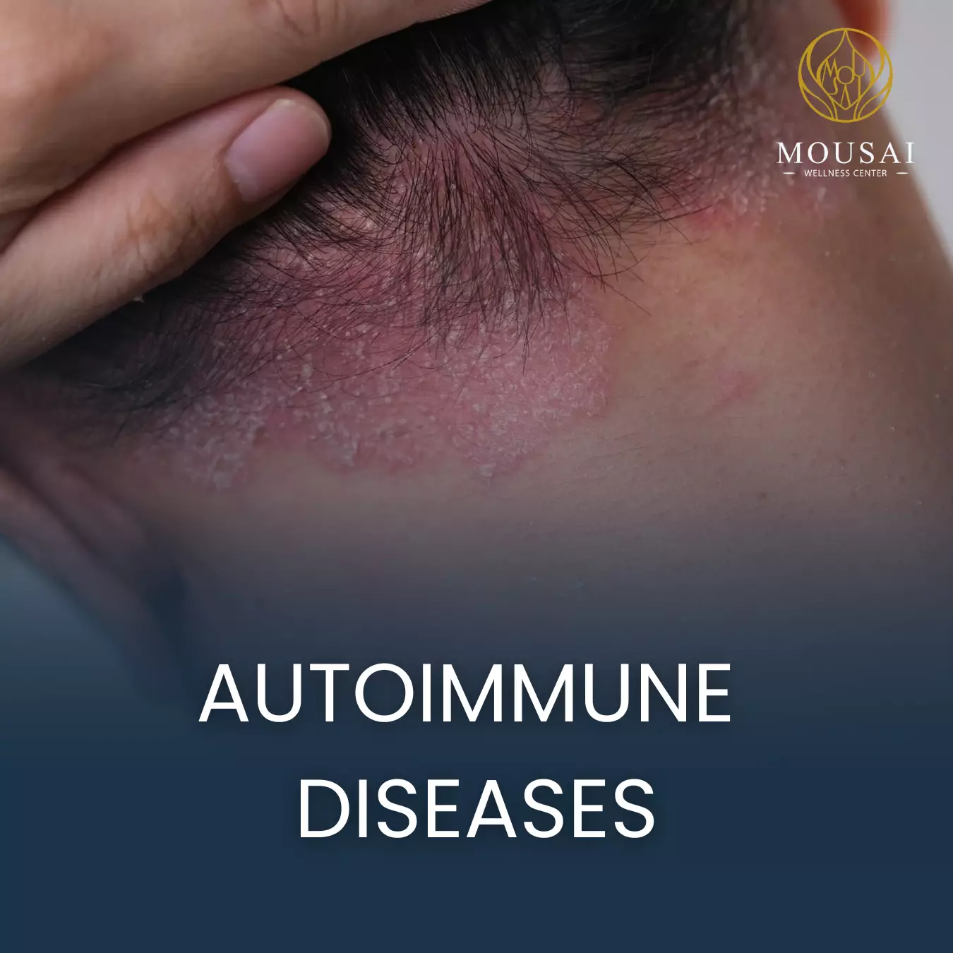 5 Autoimmune Diseases